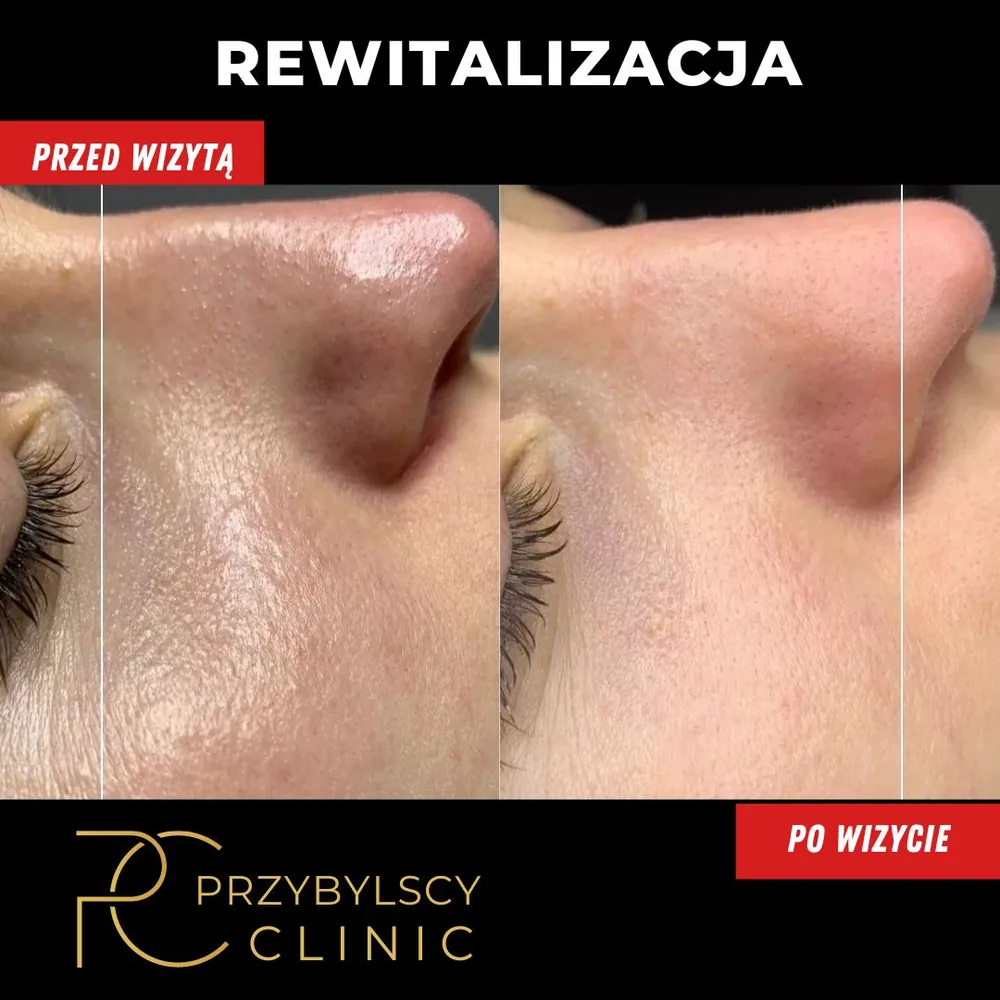 Rewitalizacja skóry przed i po oczyszczaniu wodorowym