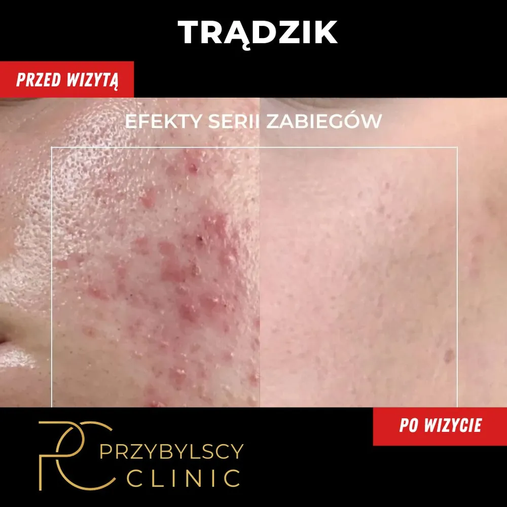 Trądzik przed i po oczyszczaniu wodorowym z pielęgnacją domową