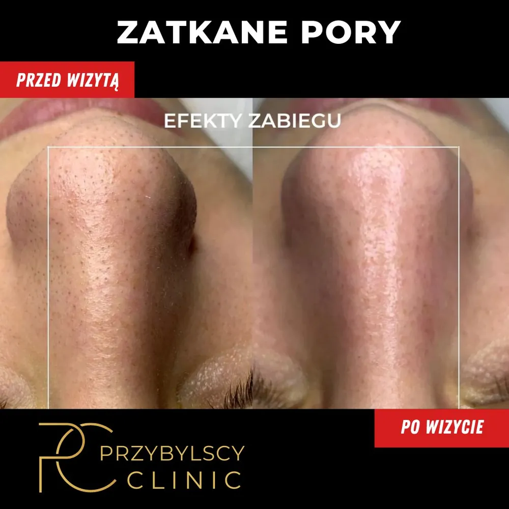 Zatkane pory przed i po oczyszczaniu wodorowym